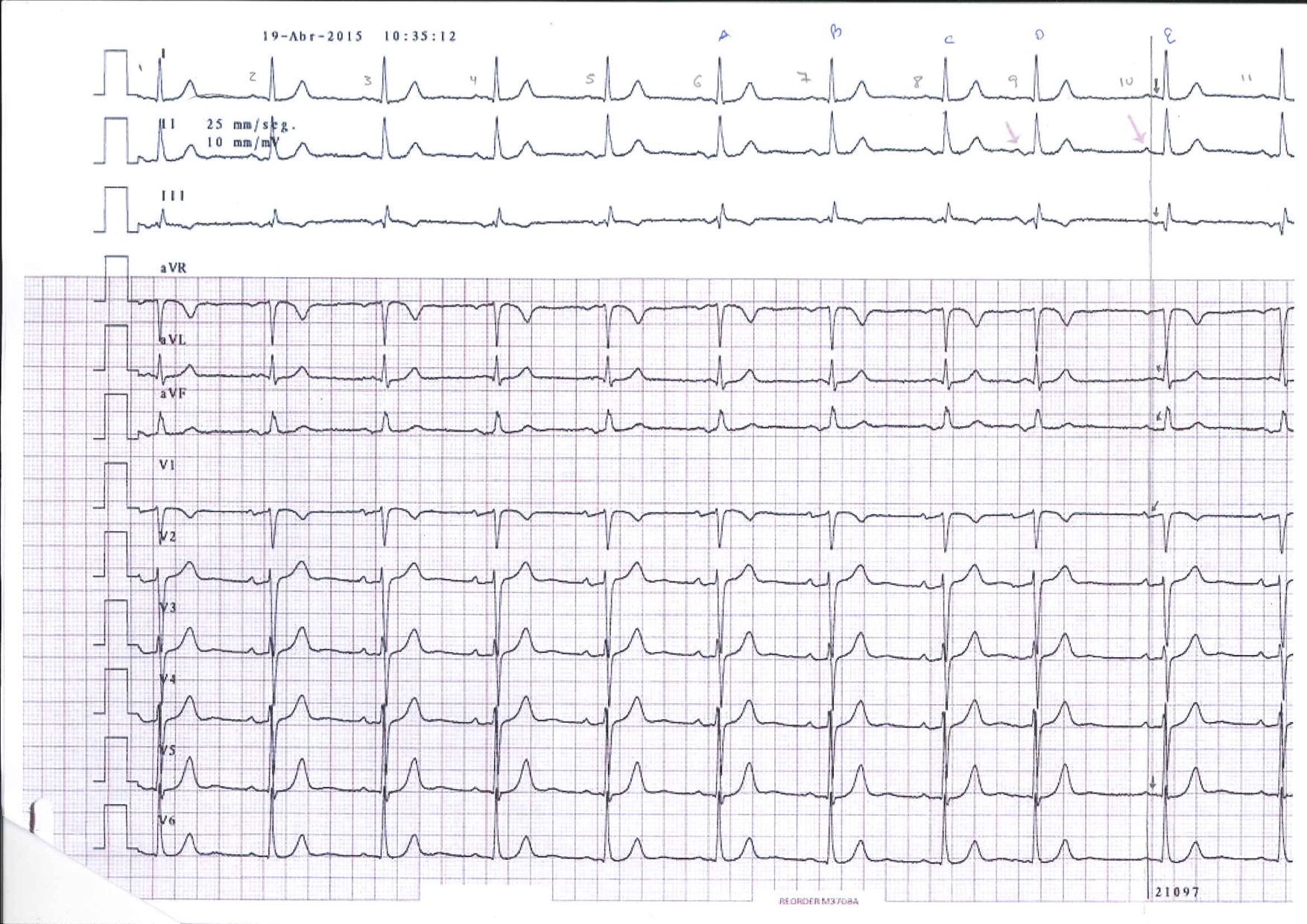 Otro ejemplo de BIA-A