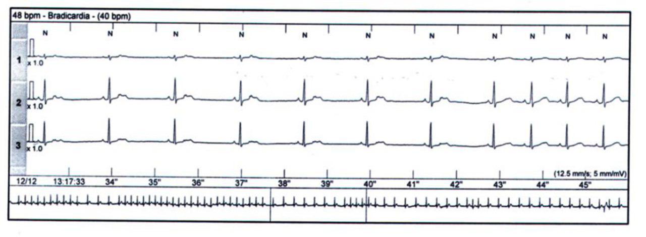 Extrasístoles auriculares bloquedas que desencadenan aleteo auricular.