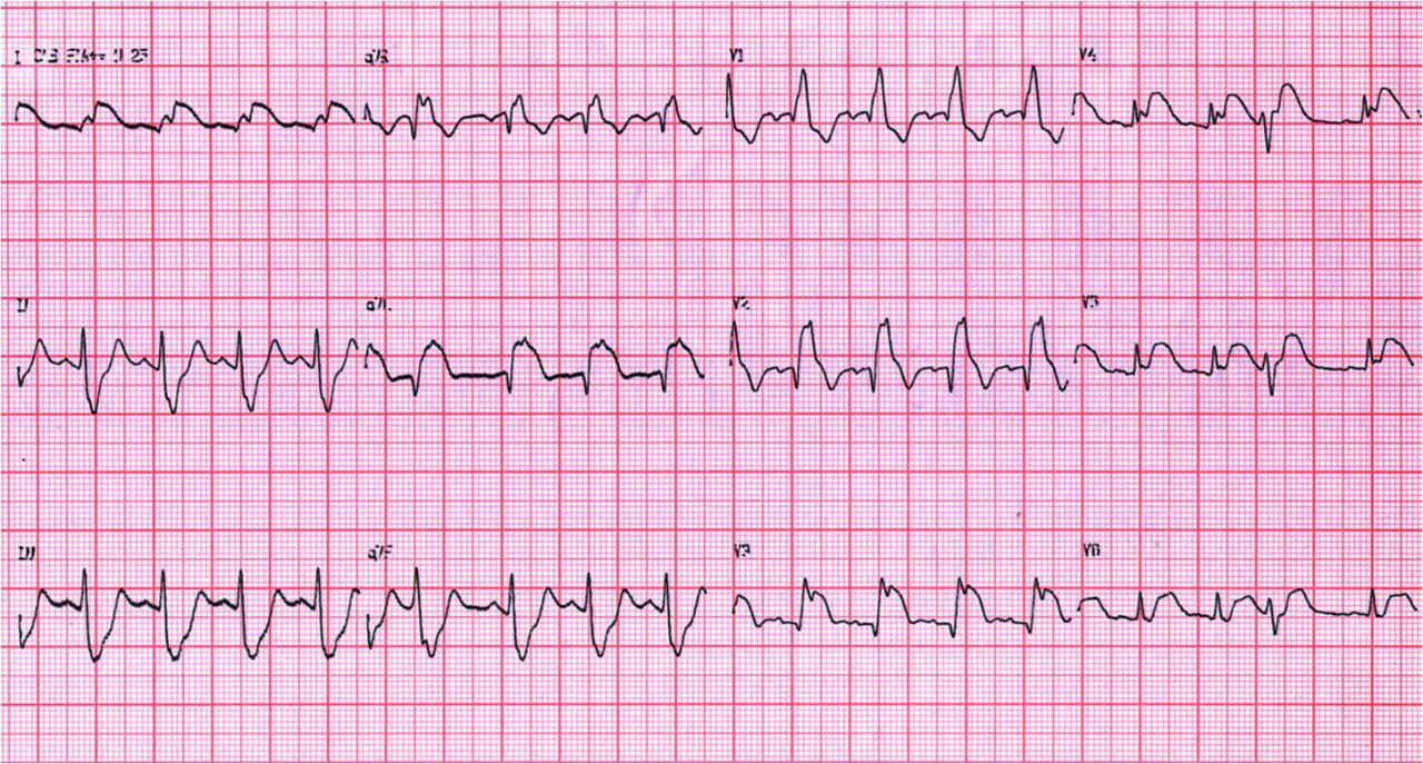 Angor prolongado y shock cardiogénico en paciente con trombofilia que fallece