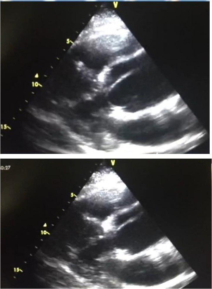 Disección aórtica en hipertenso de 46 años.