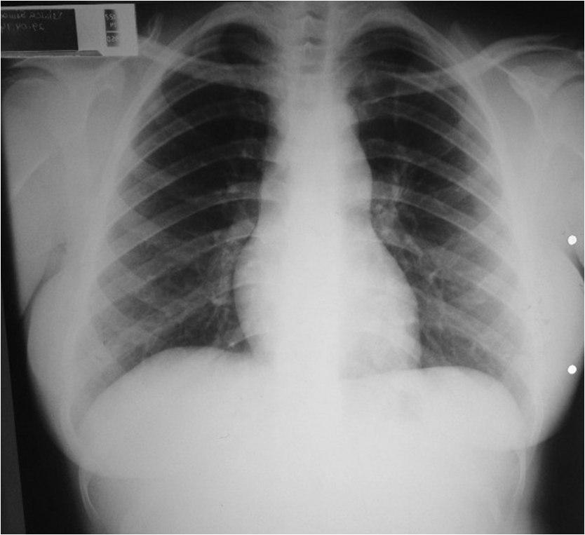 Mujer joven con soplo sistólico en foco pulmonar por estenosis valvular