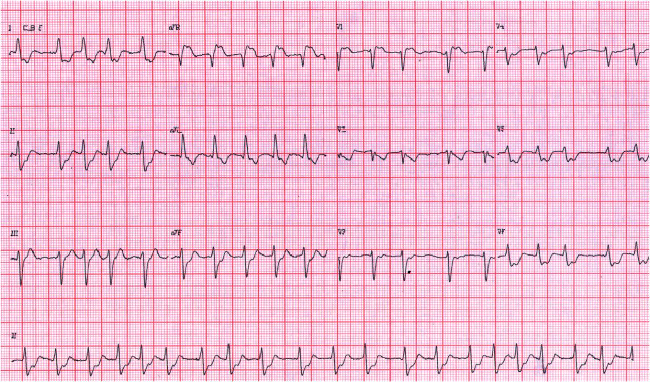 Masculino 70 años. Angor prolongado. Evoluciona a muerte por lesión de tronco de coronaria izquierda