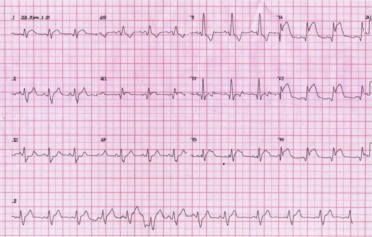 Paciente de 26 años con traumatismo de tórax por pelota de fútbol. FV y muerte
