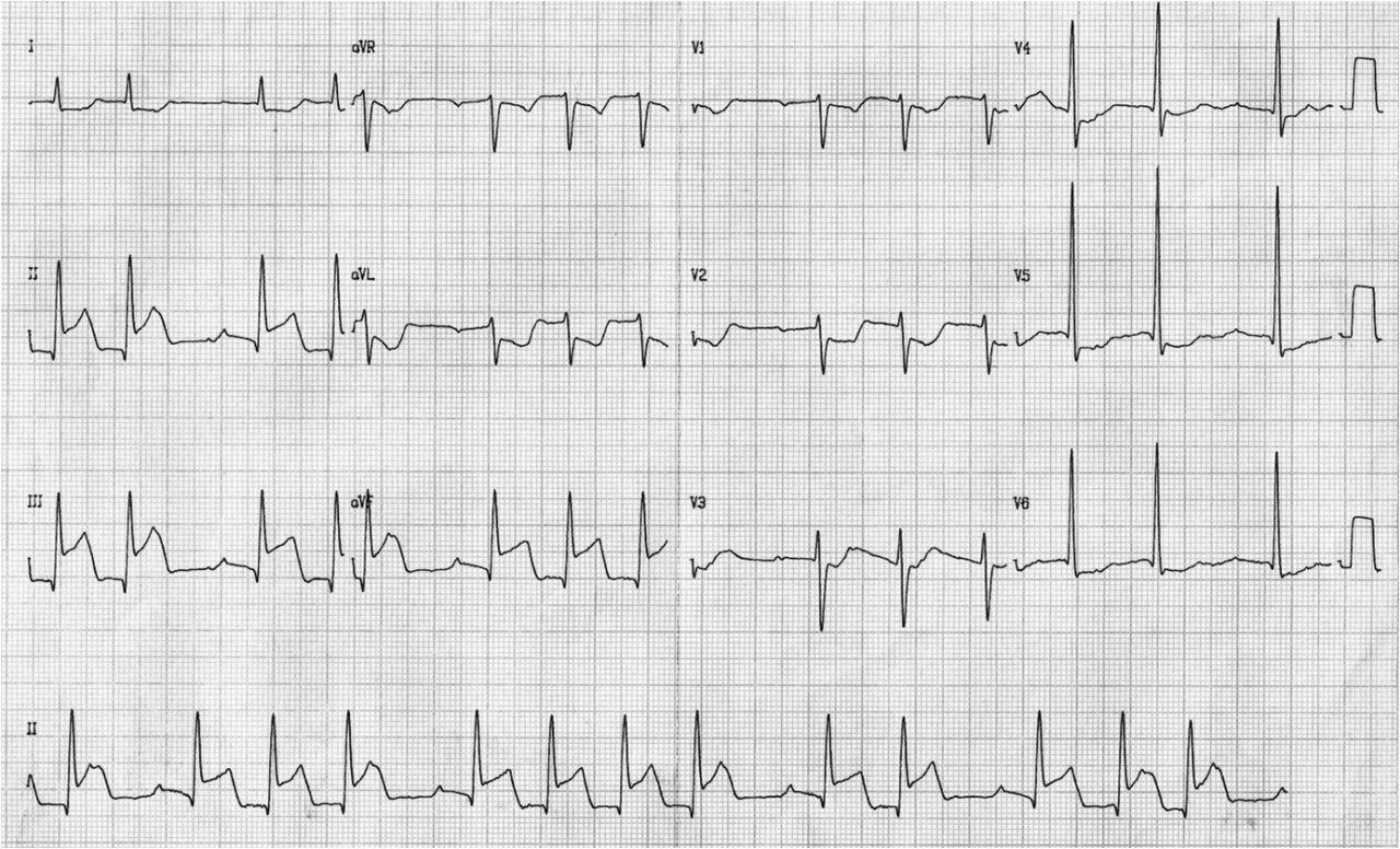 Paciente diabético e hipertenso cursando IAM diafragmático e infarto de aurícula