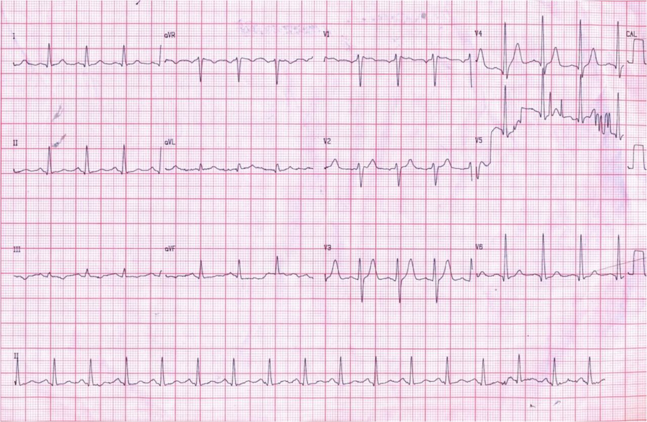 SCACEST y Síndrome de Brugada asociados