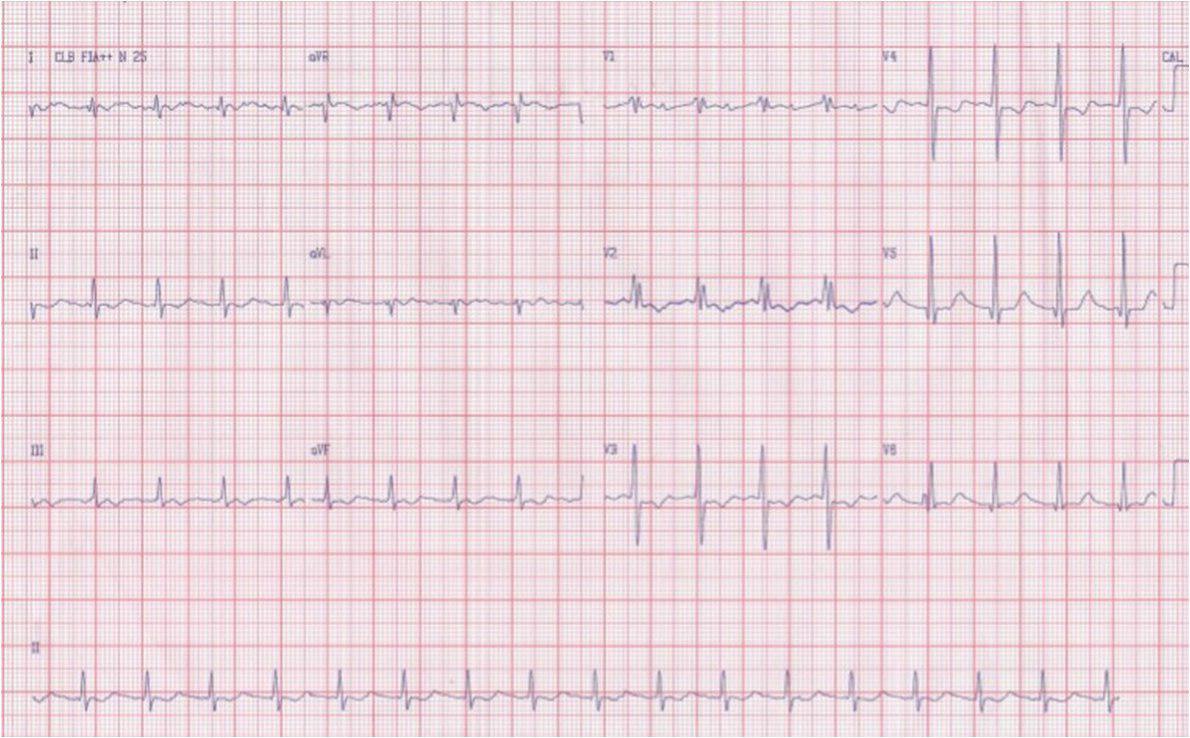 Postoperatorio inmediato de cirugía de reemplazo valvular