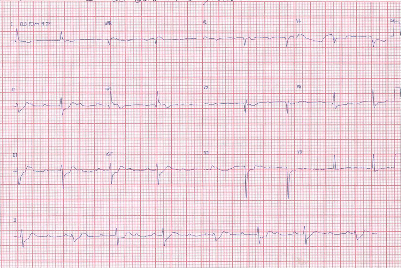 Hombre 62 años angor típico, disnea y pérdida de conciencia. Hiperpotasemia