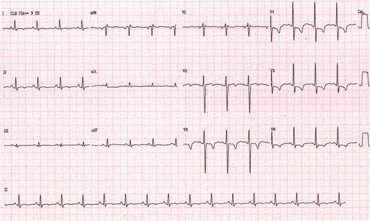 Paciente 13 años con precordialgia y fiebre de 1 semana de evolución. Signo de Spodick