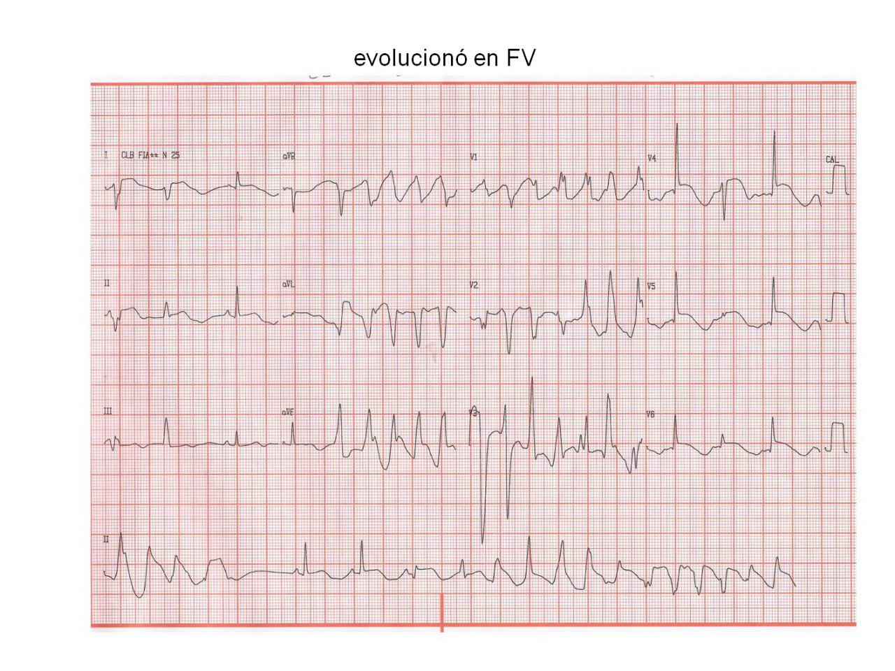 Paciente de 22 años con episodio sincopal. SQTL congénito