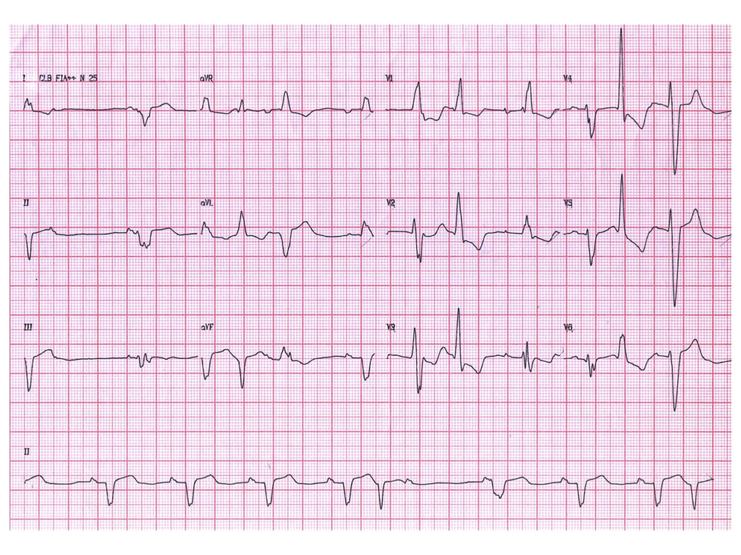 Paciente derivado para implante de marcapasos definitivo