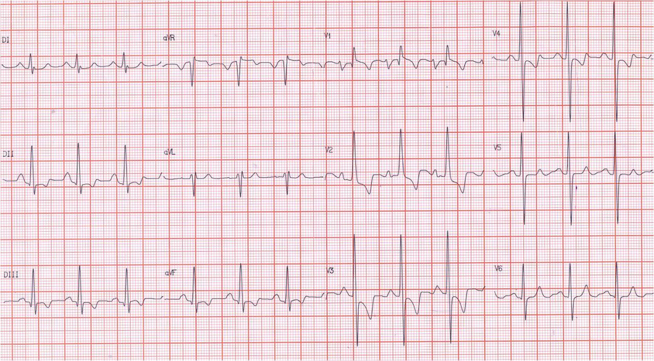 Paciente de 31 años portador de estenosis mitral reumática.