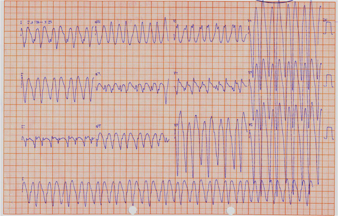 Masculino 58 años con historia familiar de MS. Síncope. Miocardiopatía hipertrófica