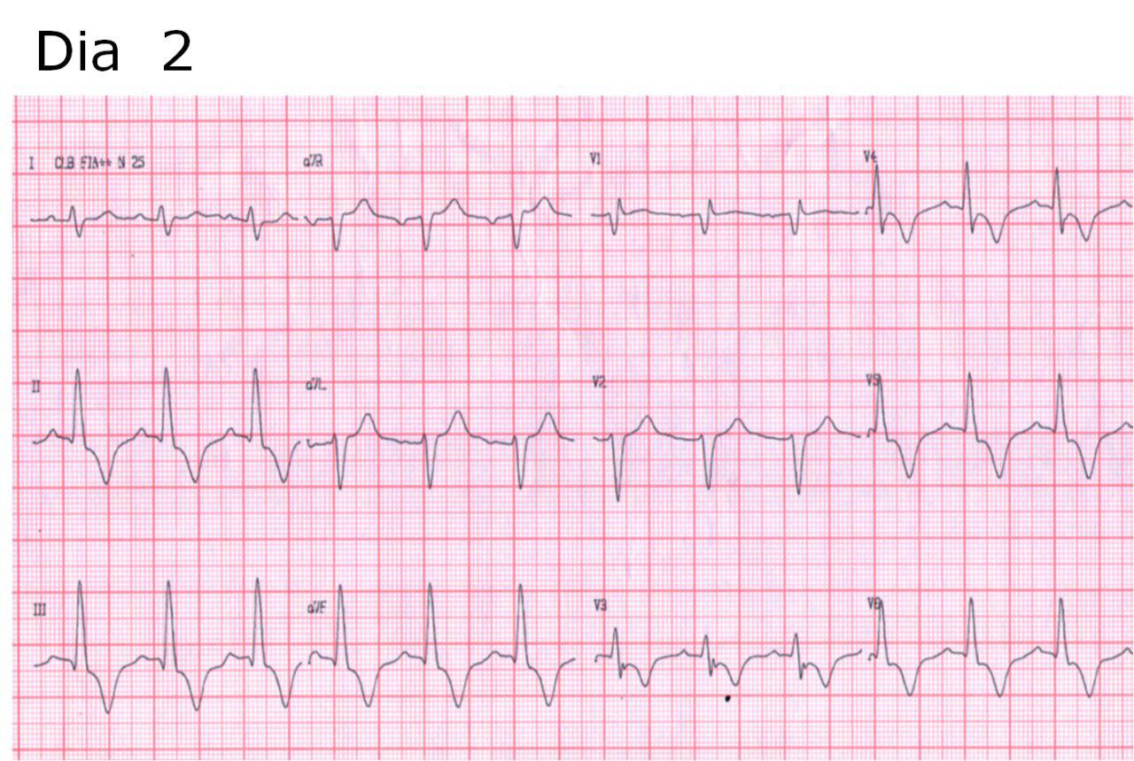 Paciente masculino de 78 años HTA con síncope. Síndrome de Rosenbaum
