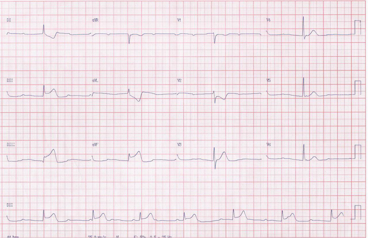 Masculino 63 años con IAM inferior y extensión a VD complicado con BAV