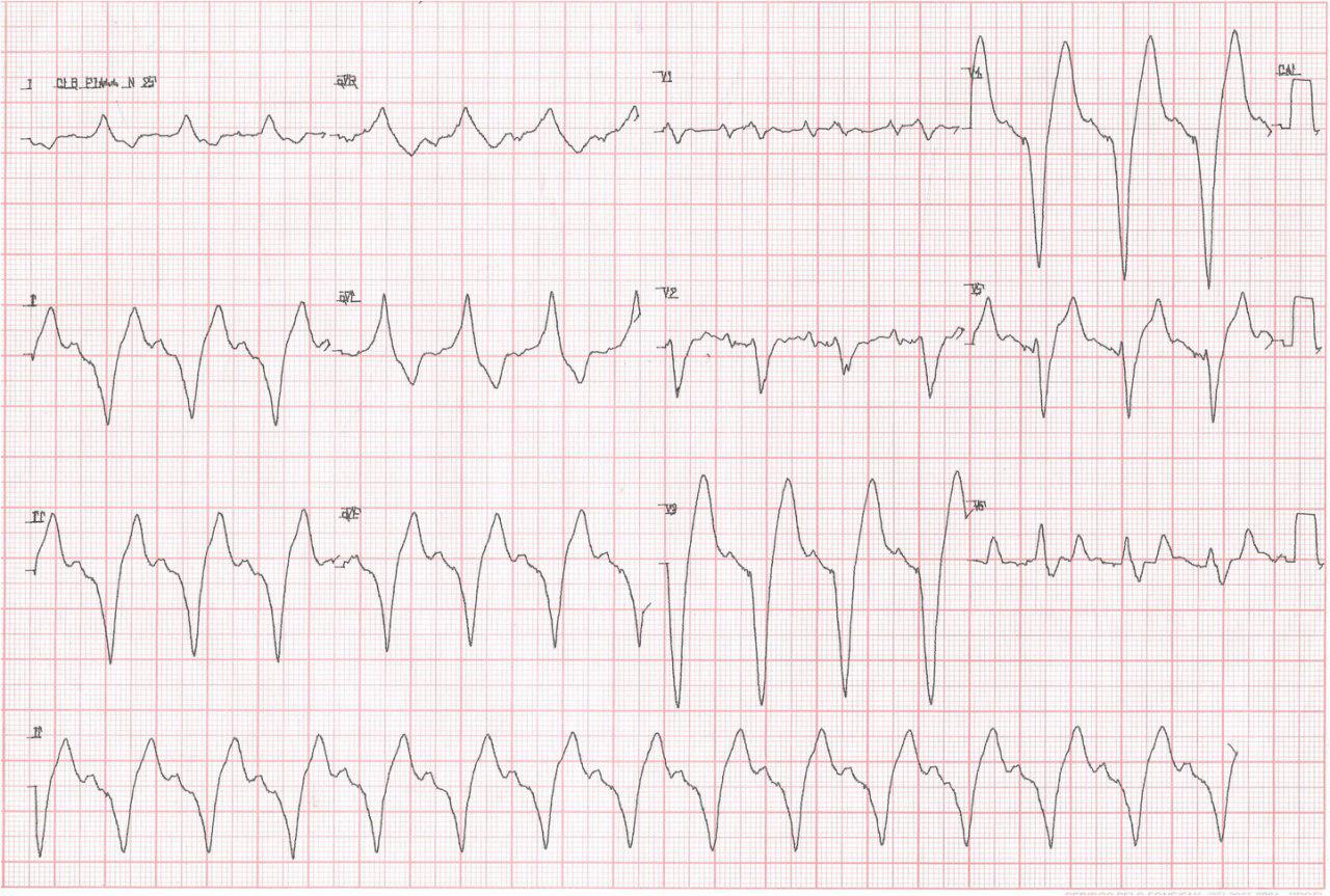 Empeoramiento de la Insuficiencia cardiaca  2 días tras el implante de un  MP bicameral. HiperK