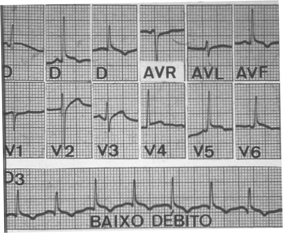 Paciente con cuadro de pericarditis purulenta con bajo gasto cardíaco por lo que se drena mediante punción guiada por ECG