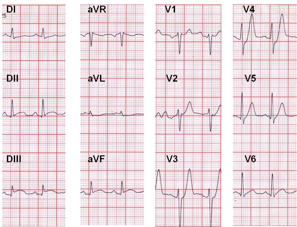 Paciente de 58 años con patrón de Winter en el ECG por trombo suboclusivo en la DA.