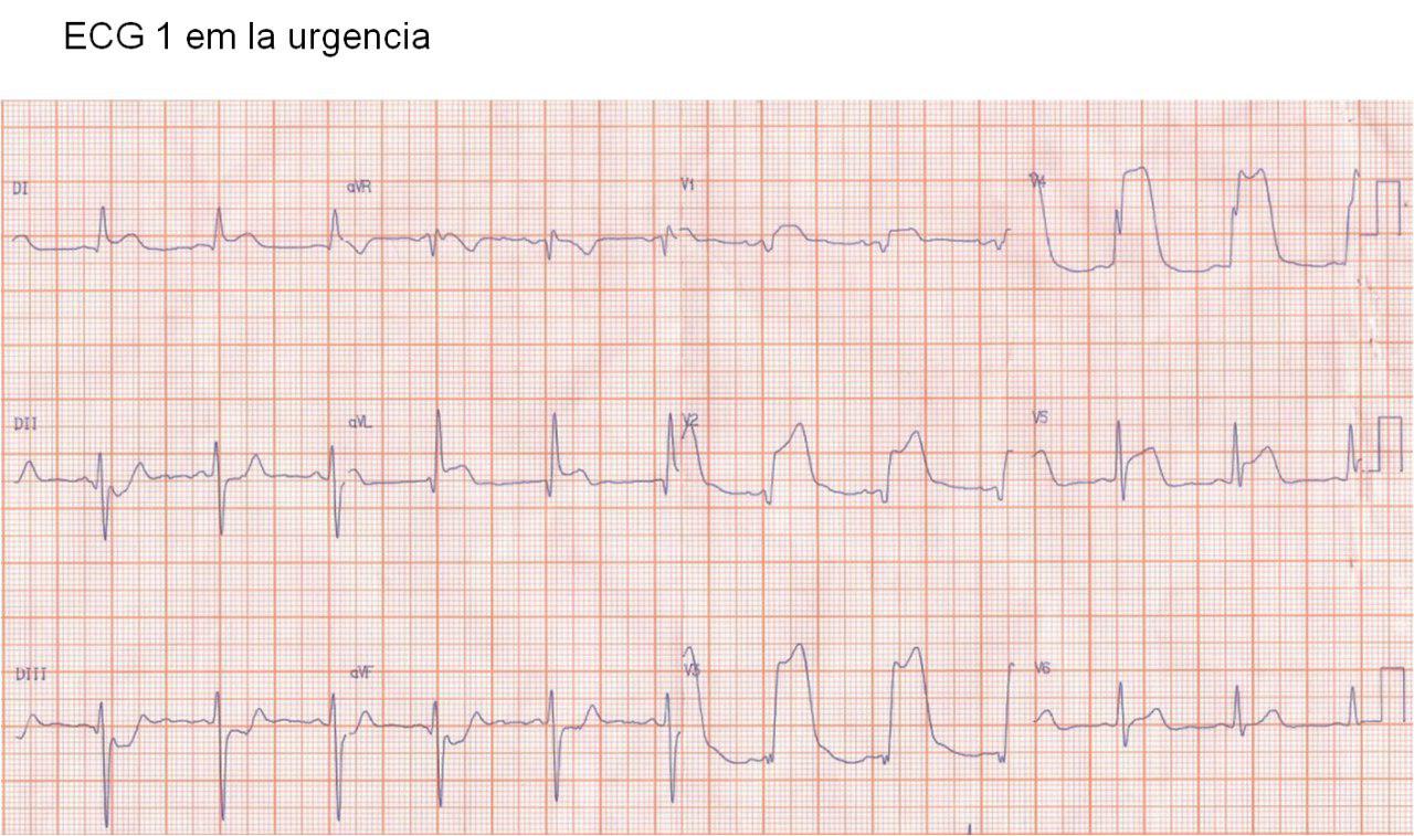 Paciente con angor prolongado. Tombstoning ST- Elevation Myocardial Infarction
