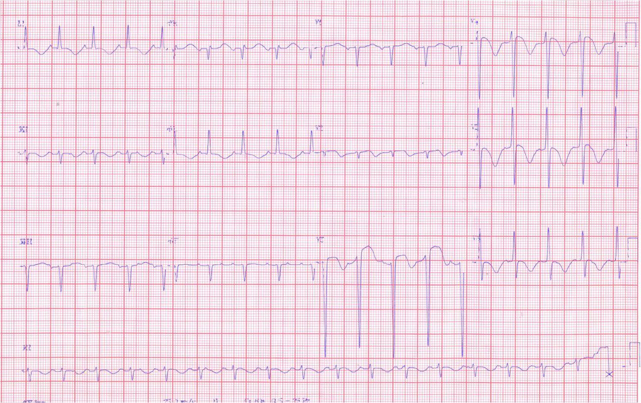 Paciente 45a con convulsiones. CCG normal. Masa ocupante cerebral. Tumor o hemorragia