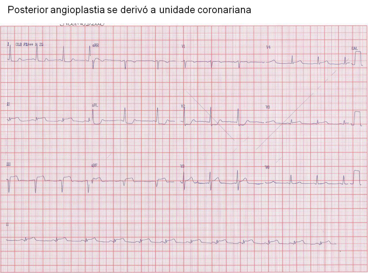 Trombosis del stent con aspiración ulterior del trombo