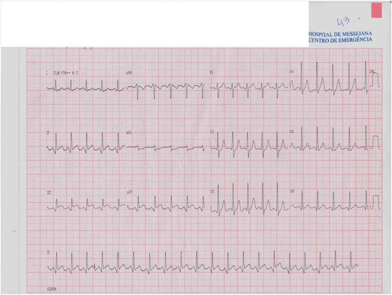 Masculino de 38 años con dolor abdominal, sudoración y vómitos. Pancreatitis aguda