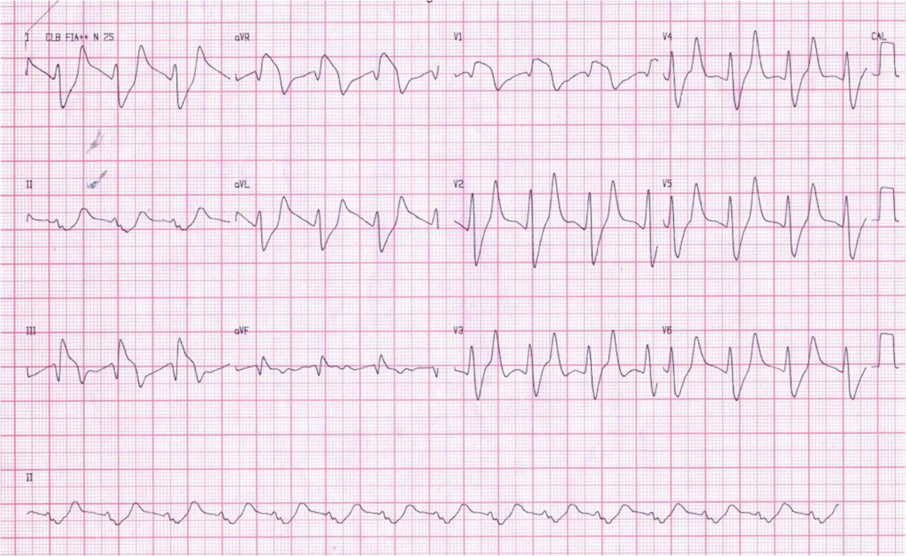 Femenina 69 años con hiperpotasemia 10 meq/l. Lenta normalización