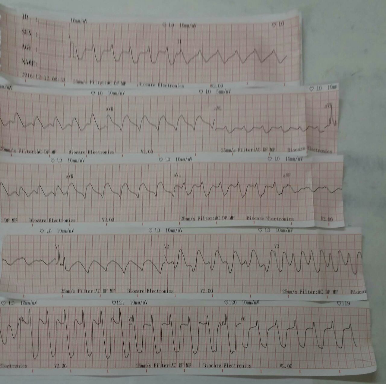 Hiperpotasemia de 8 mEq/l