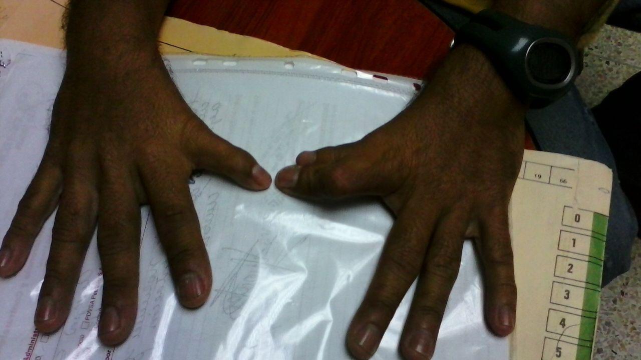 Síndrome de Holt Oram