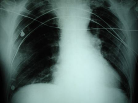 Lesión osteolítica de costilla por mieloma múltiple