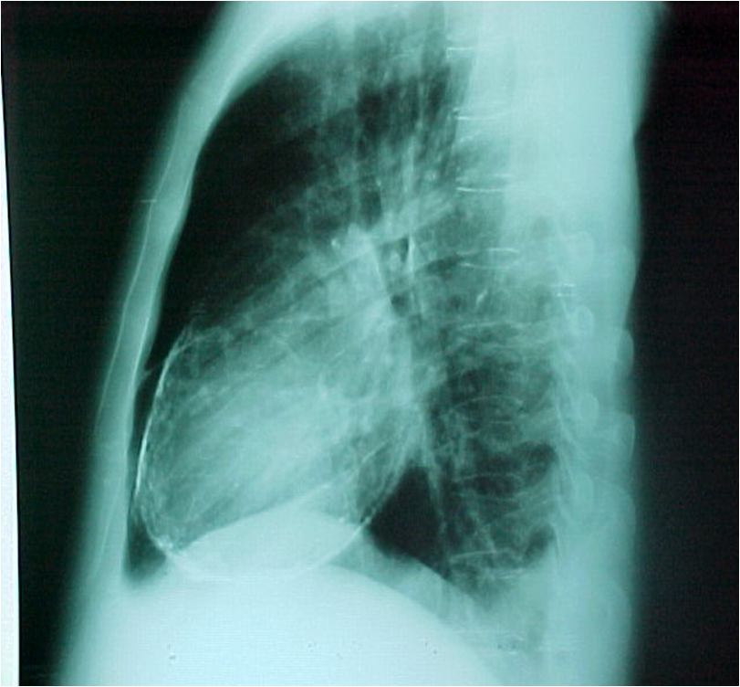 Pericarditis constrictiva