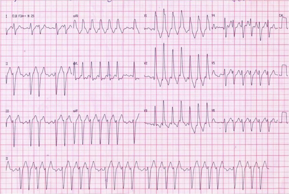 Femenina 86 a. Demencia. Atc de ACV embólico. Síndrome de Bayes.