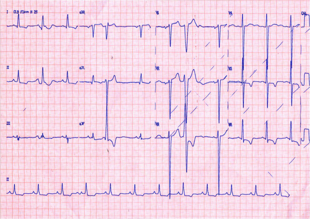 Paciente masculino 72 años, hipertenso, con dolor retroesternal por disección aórtica tipo B