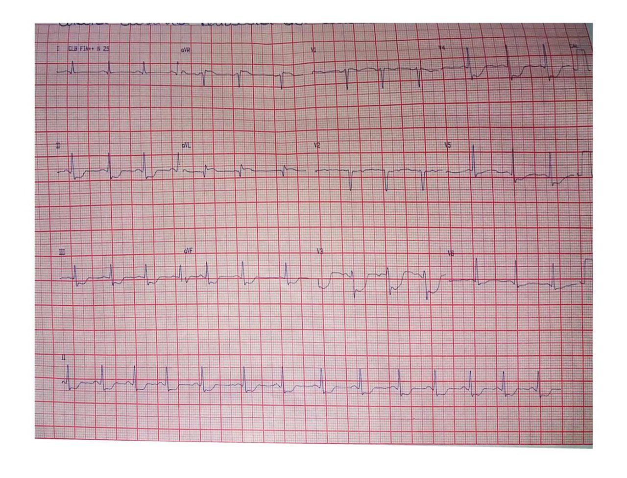 Femenina de 25 años con dolor anginoso prolongado. Disección espontánea de arteria DA