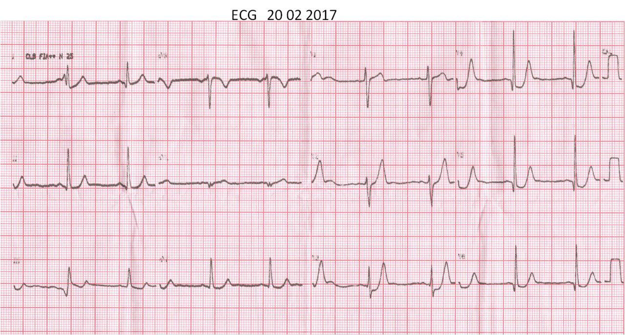 Paciente masculino 47 años con angor típico post ejercicio. Patrón de Winter por obstrucción de DA proximal
