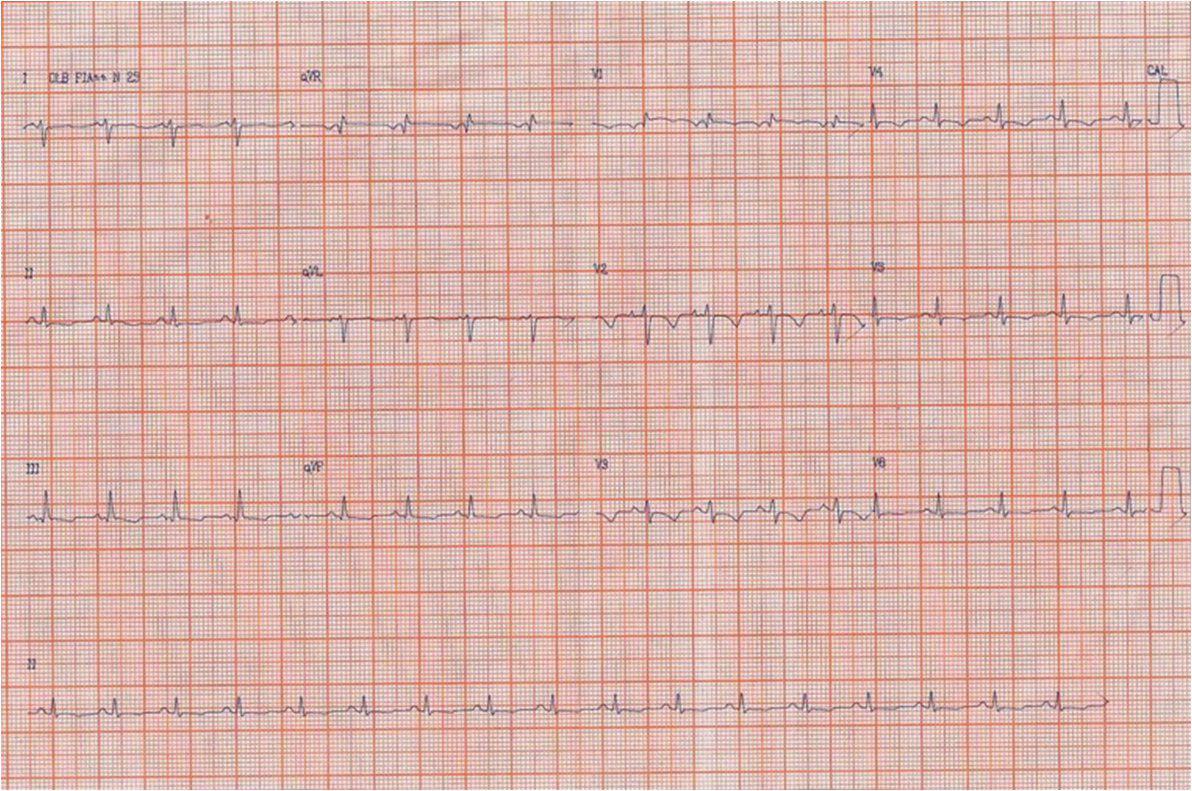 Femenina 30 años con cuadro de Tromboembolismo pulmonar.
