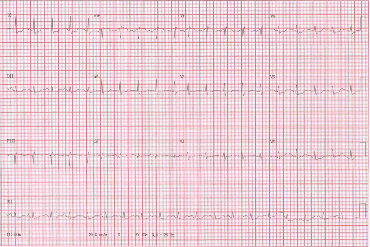 Masculino 63a con TEP reperfundido con trombolisis. ACV  y muerte