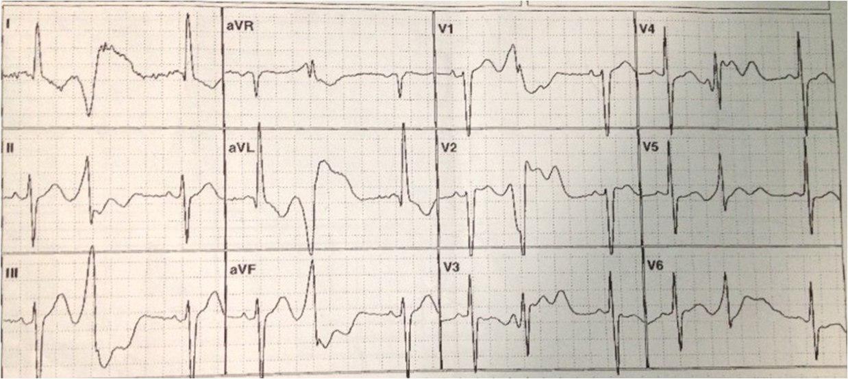 Paciente 71 años medicado con hidroclorotiazida, presenta ondas U gigantes.