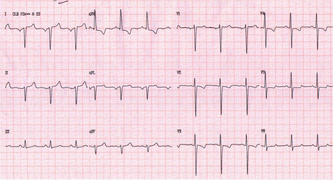 Paciente de 53 años portador de dextrocardia presenta IAMCEST por oclusión de Tronco de CI
