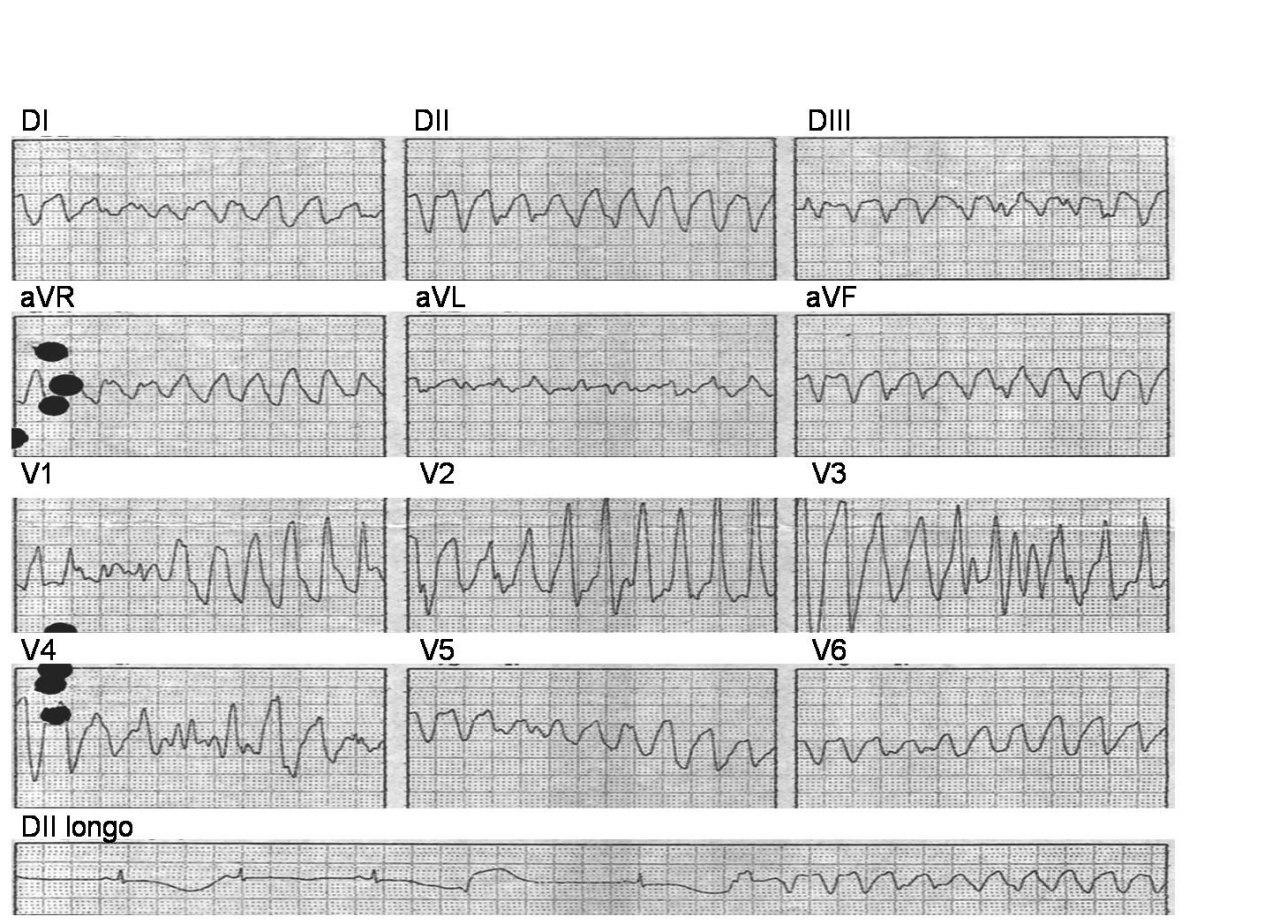 Paciente 21 años ingresa por síncope. SQTL Romano Ward
