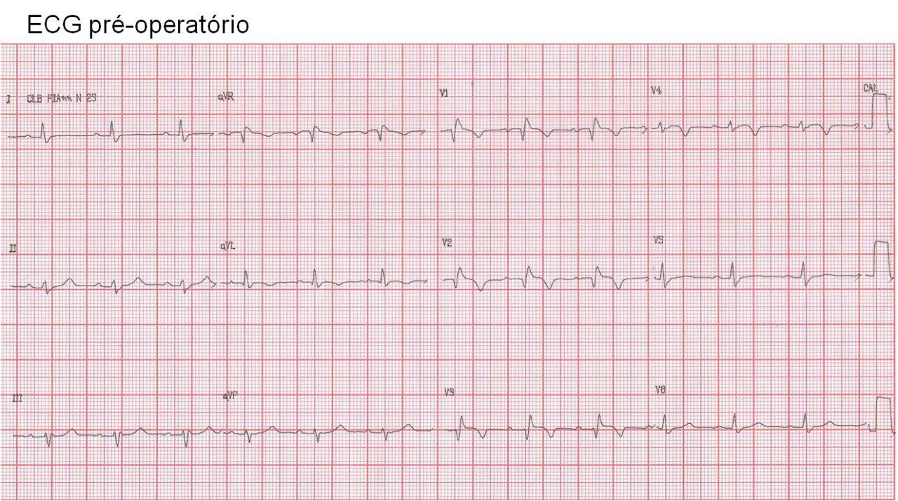 Postoperatorio de cirugía de revascularización miocárdica y endarterectomía carótidea