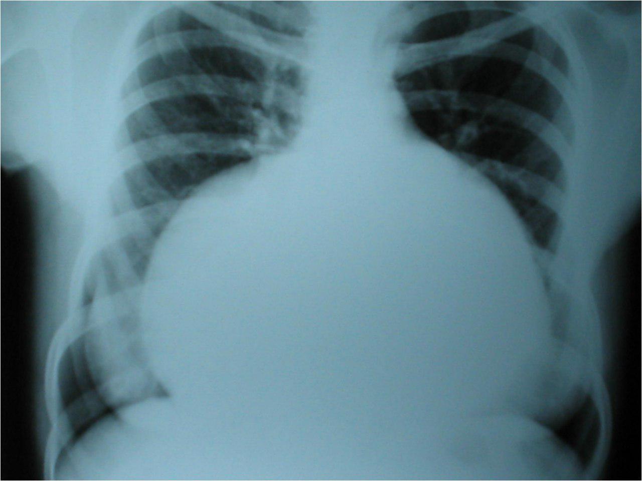 Mujer de 28 años con reemplazo valvular mitral con pannus cicatrizal. Disnea y disfagia