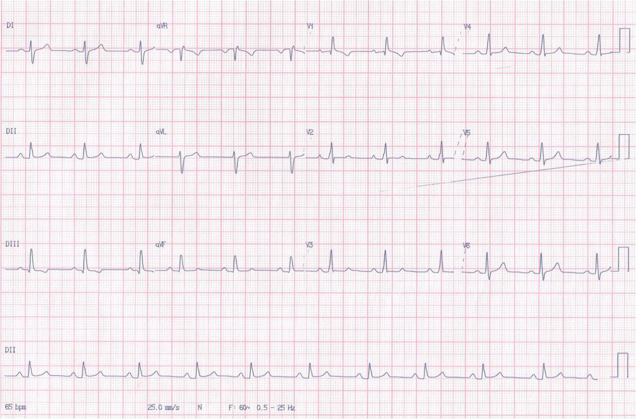 Mujer de 23 años con soplo cardíaco por CIA