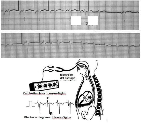 Mujer joven con doble vía de conducción AV