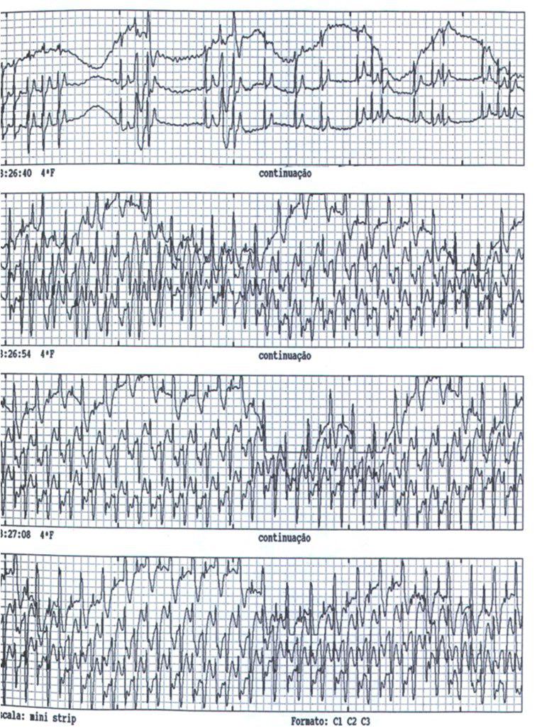 Paciente masculino de 13 años con historia de síncope recurrente de esfuerzo y MS familiar