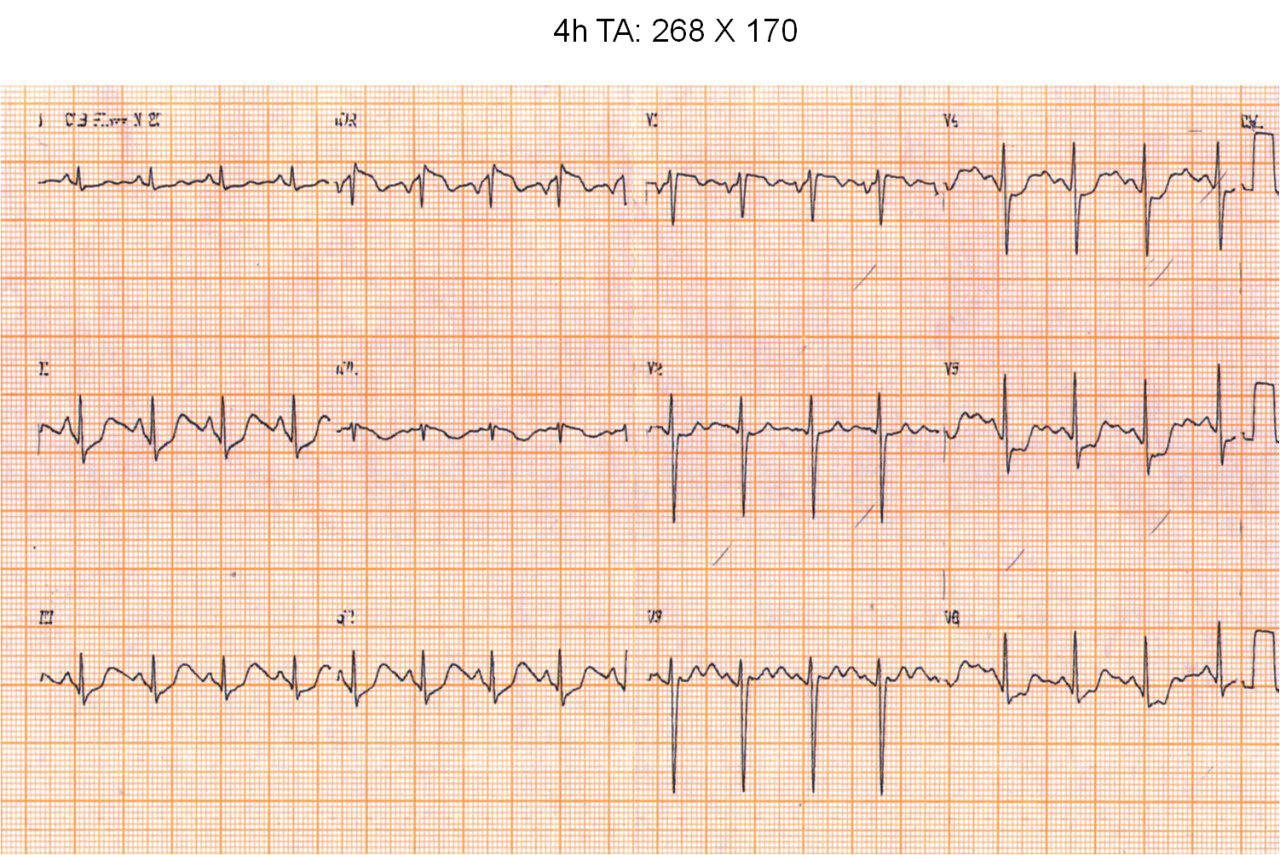 Femenina de  37a sin atc. Hipertensión maligna. Dolor precordial. Paro cardíaco irreversible. Coronarias normales