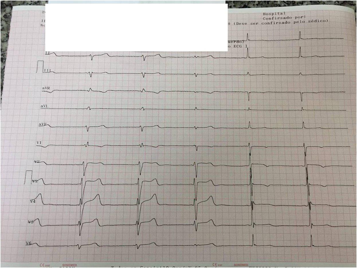 Disautonomía por Traumatismo raquimedular por herida de un proyectil de arma de fuego