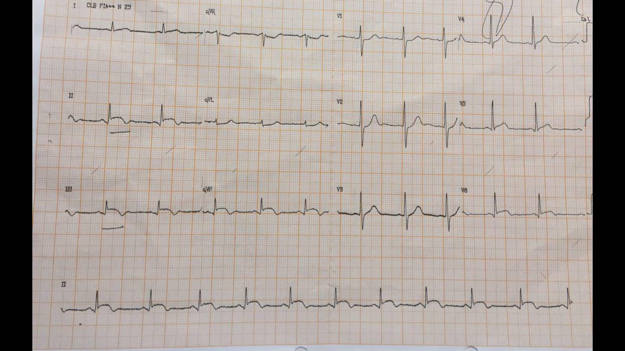 Miocarditis focal en joven de 19 años con típico realce tardío mesocárdico en la RNM