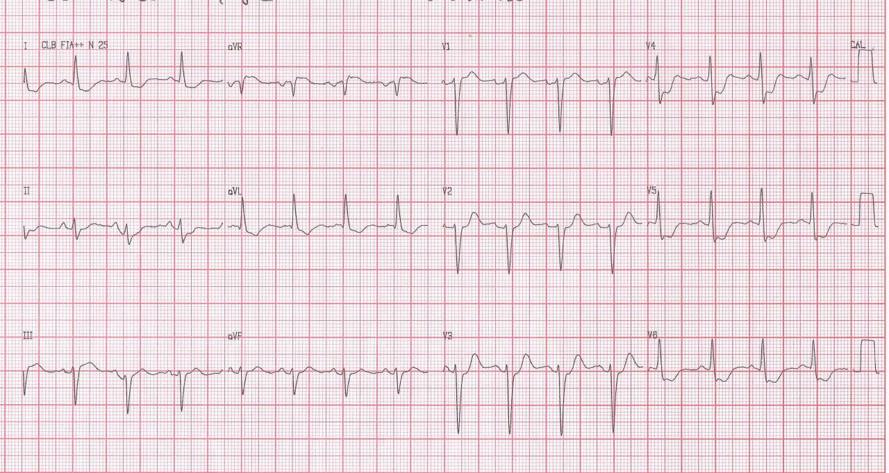 Mujer 79 años, diabética. Angor prolongado típico acompañado de sudoración fría y nauseas