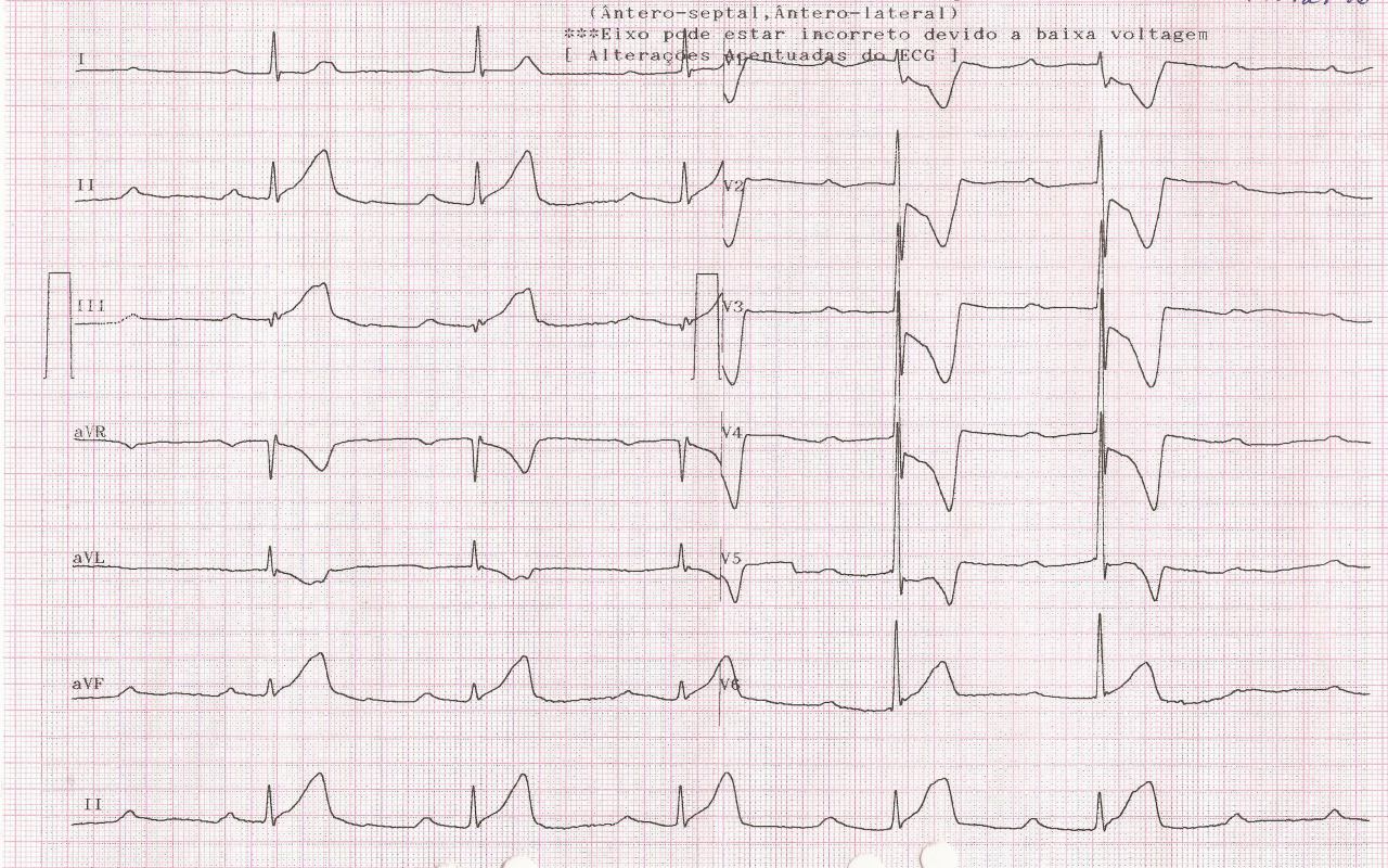 Masculino 65 años, diabético, con sudoración fría y agitación psicomotriz