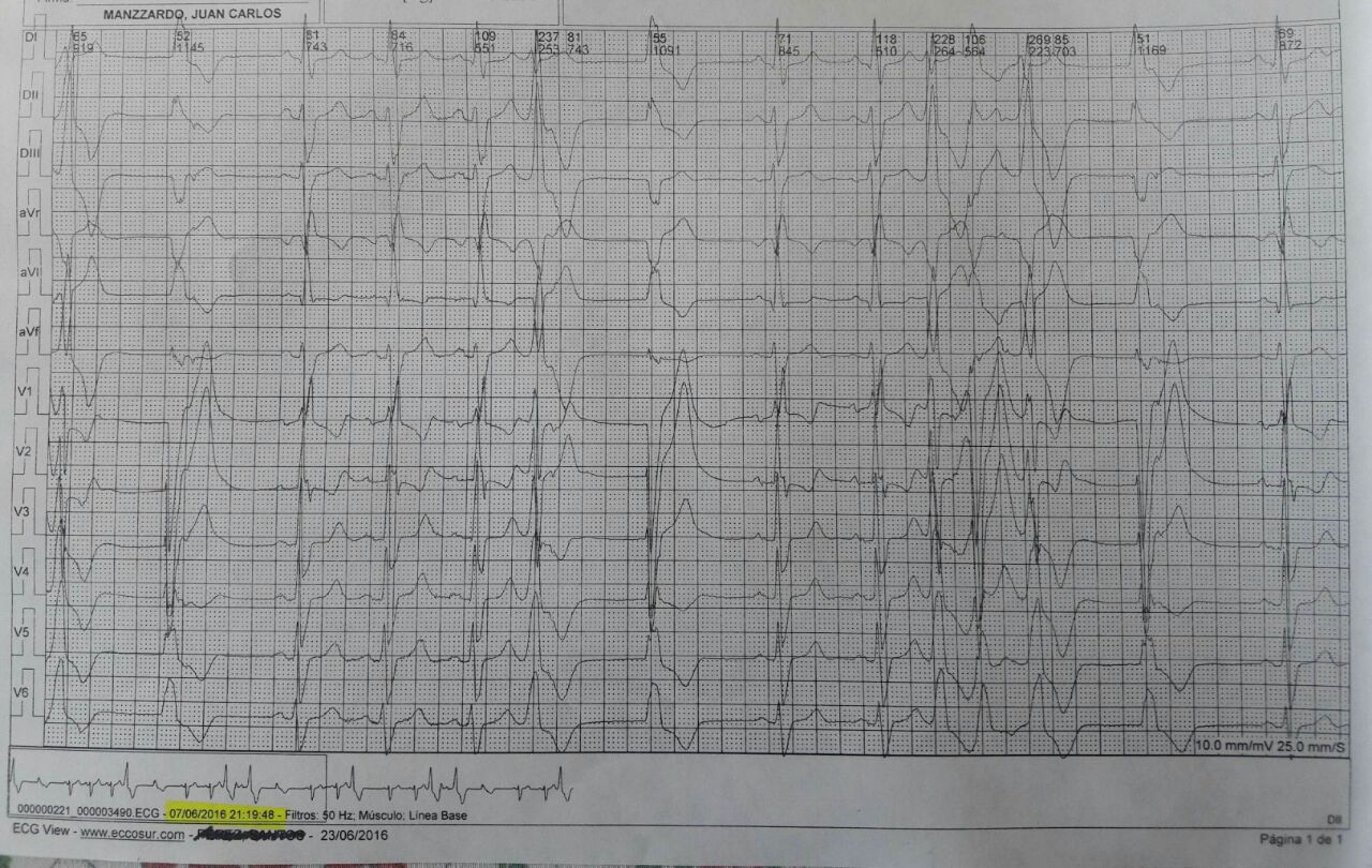 Masculino 64 años. Reemplazo valvular aórtico hace 4 años